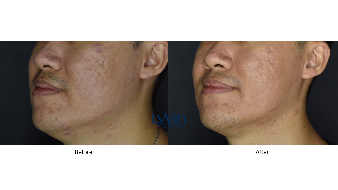 Potenza RF microneedling before and after photo showing acne scar reduction